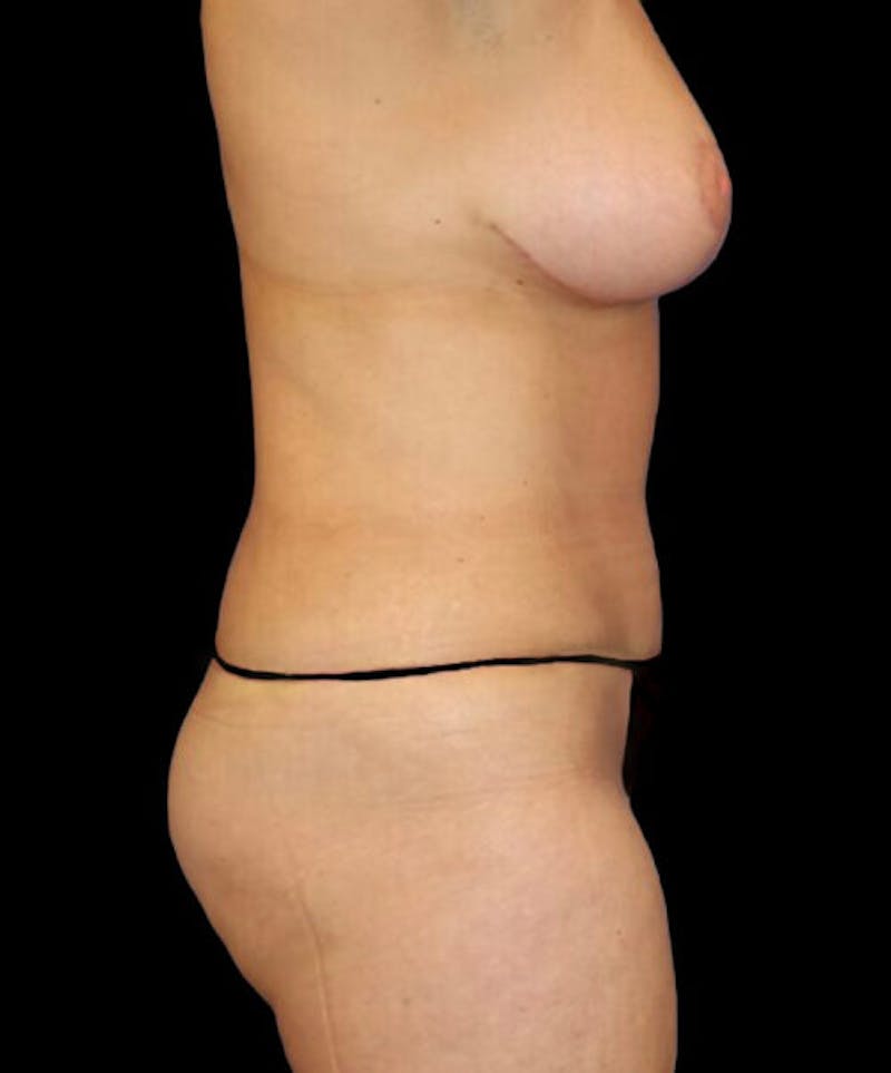 Mommy Makeover Before & After Gallery - Patient 234259 - Image 6