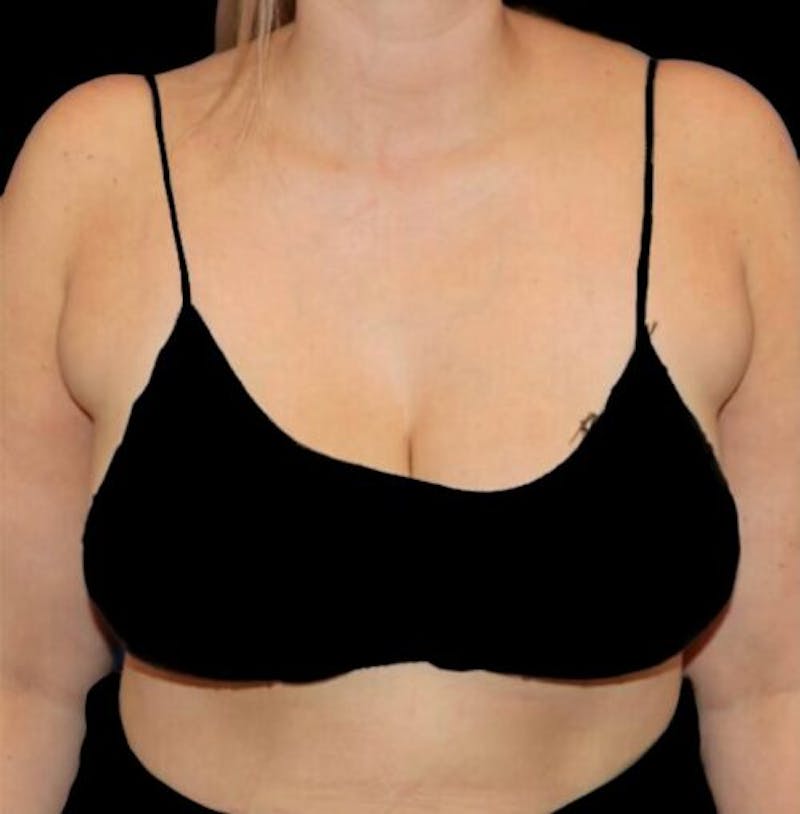 Pre-Axillary ‘Bra Bulge’ Liposuction Before & After Gallery - Patient 373160 - Image 1