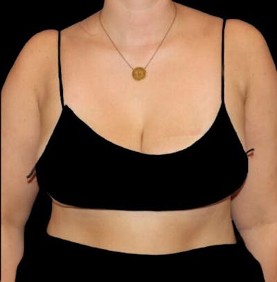 Pre-Axillary ‘Bra Bulge’ Liposuction Before & After Gallery - Patient 373160 - Image 2