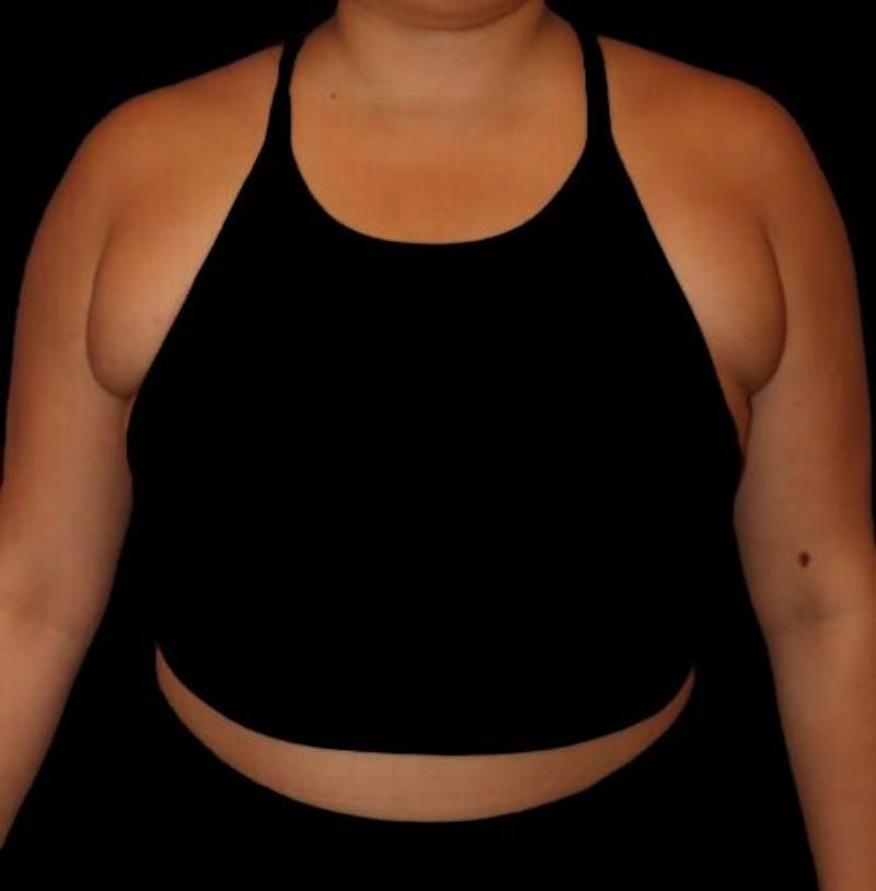 Pre-Axillary ‘Bra Bulge’ Liposuction Before & After Gallery - Patient 440691 - Image 1