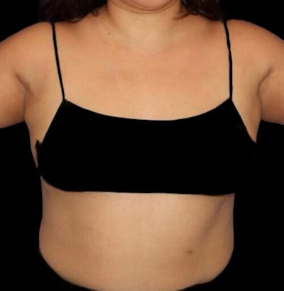 Pre-Axillary ‘Bra Bulge’ Liposuction Before & After Gallery - Patient 440691 - Image 2
