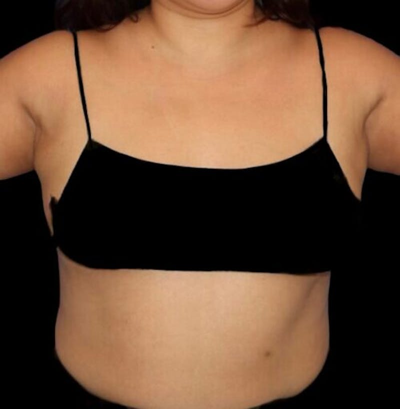 Pre-Axillary ‘Bra Bulge’ Liposuction Before & After Gallery - Patient 440691 - Image 2