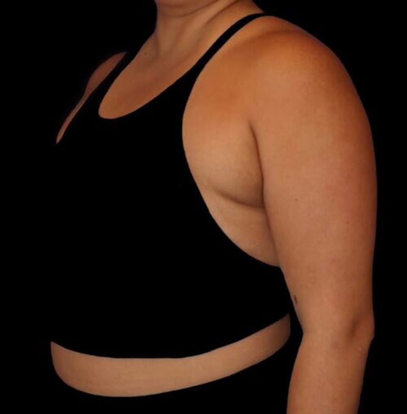 Pre-Axillary ‘Bra Bulge’ Liposuction Before & After Gallery - Patient 440691 - Image 3