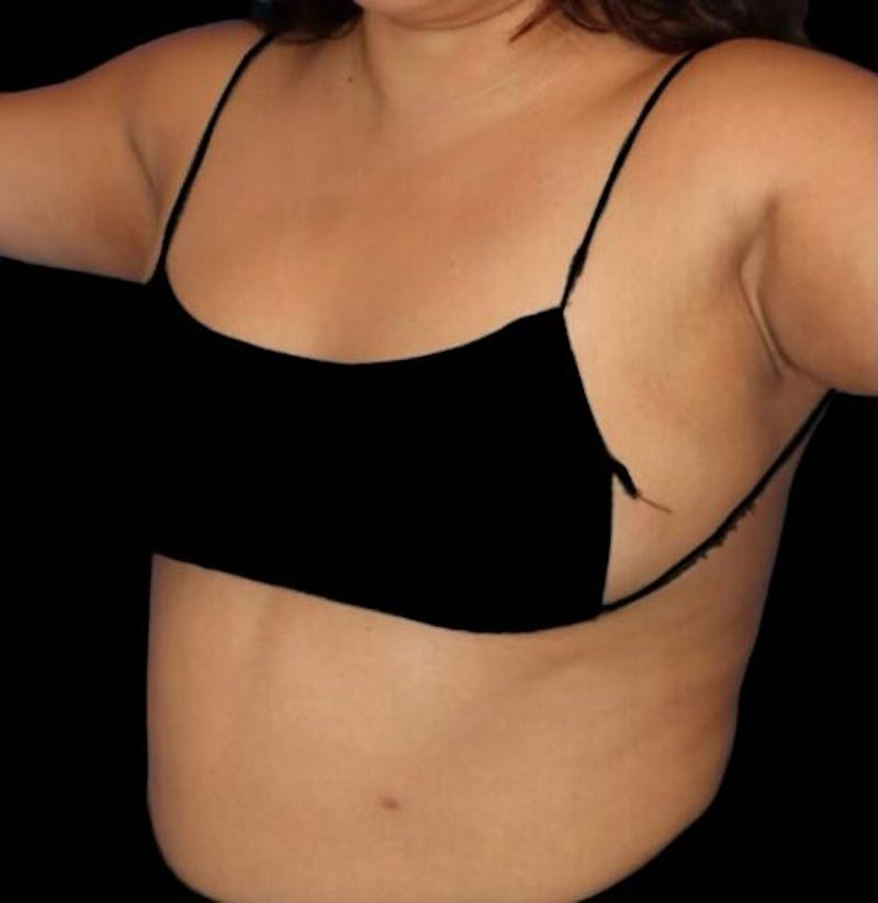 Pre-Axillary ‘Bra Bulge’ Liposuction Before & After Gallery - Patient 440691 - Image 4
