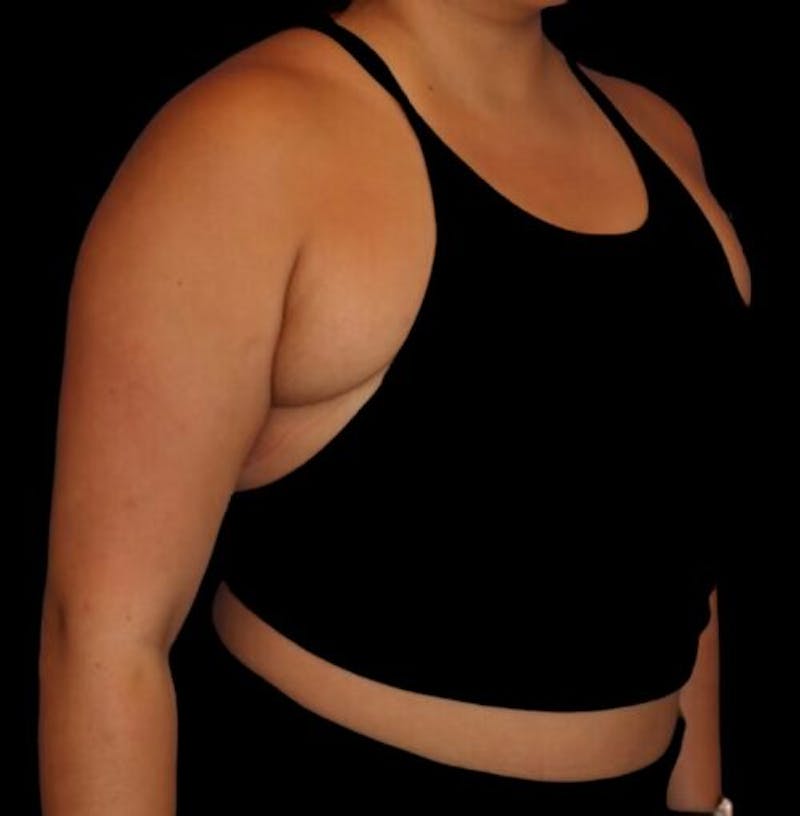 Pre-Axillary ‘Bra Bulge’ Liposuction Before & After Gallery - Patient 440691 - Image 5