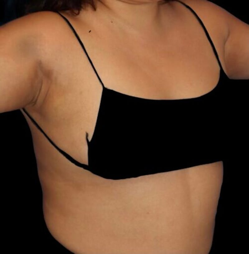 Pre-Axillary ‘Bra Bulge’ Liposuction Before & After Gallery - Patient 440691 - Image 6