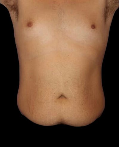Male Liposuction Before & After Gallery - Patient 280853 - Image 1