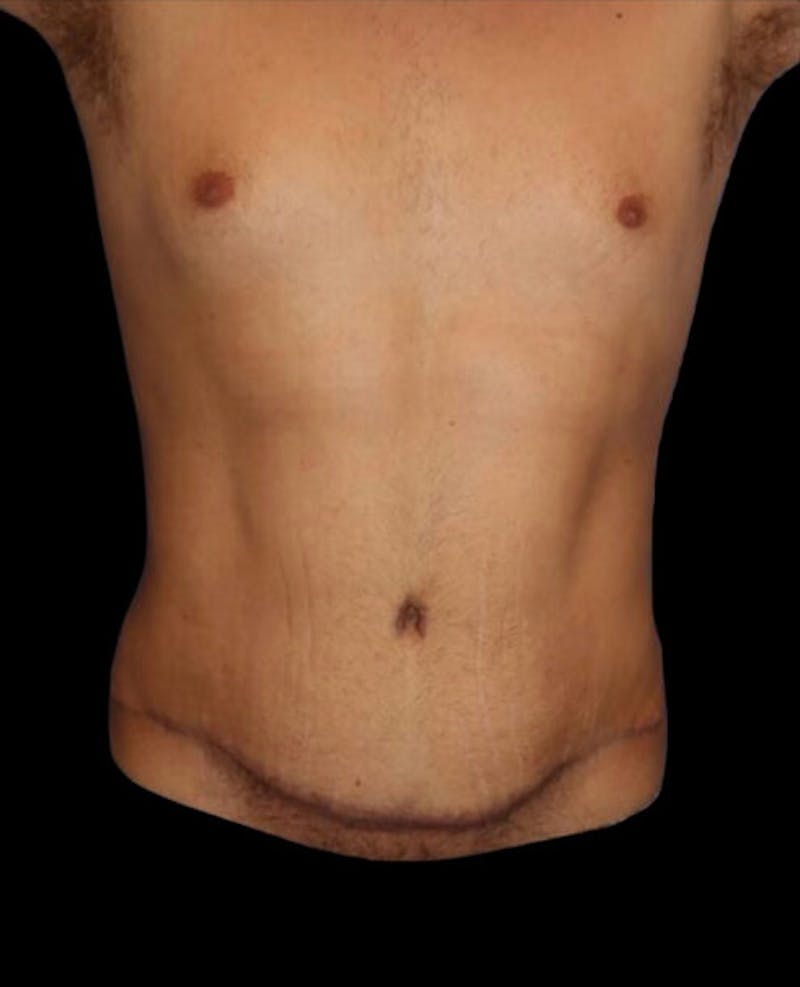 Male Liposuction Before & After Gallery - Patient 280853 - Image 2