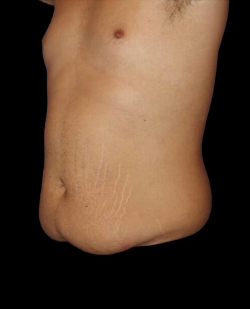 Male Liposuction Before & After Gallery - Patient 280853 - Image 3
