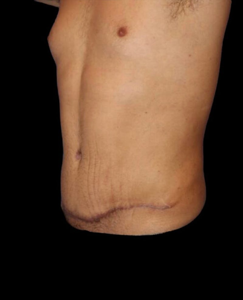 Male Liposuction Before & After Gallery - Patient 280853 - Image 4