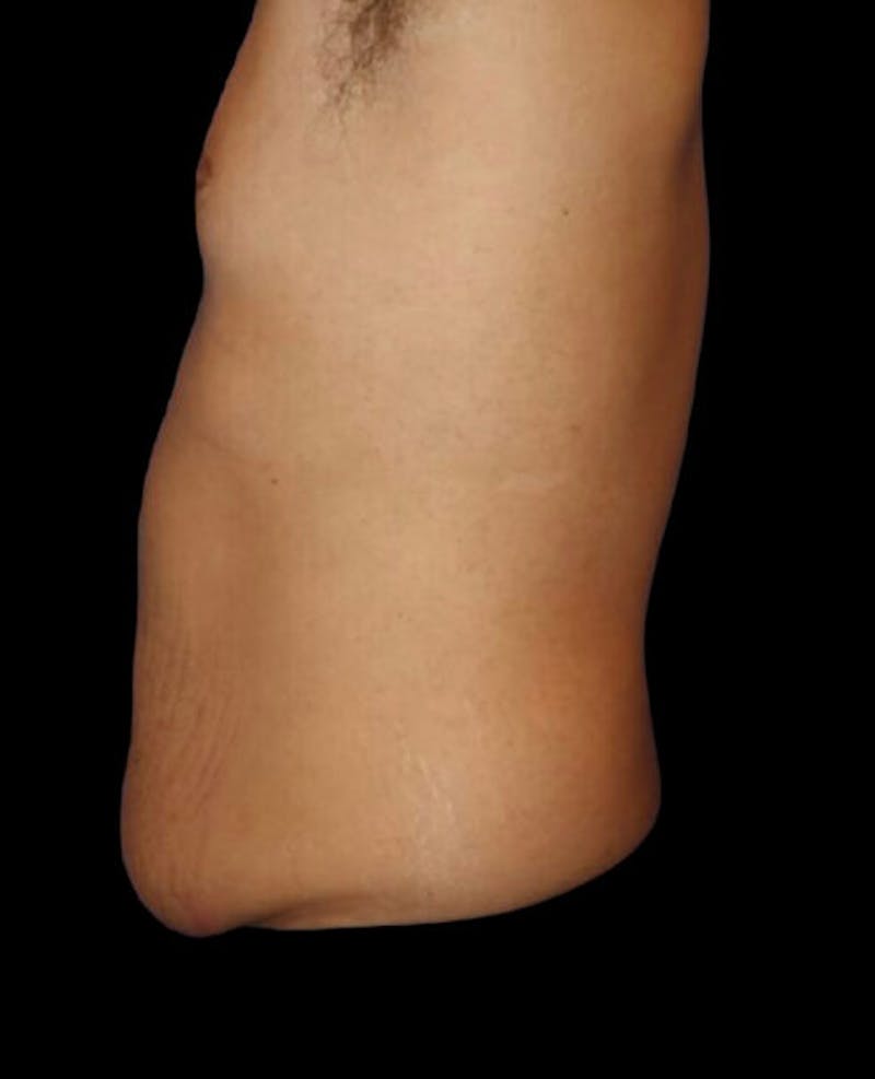 Male Liposuction Before & After Gallery - Patient 280853 - Image 5