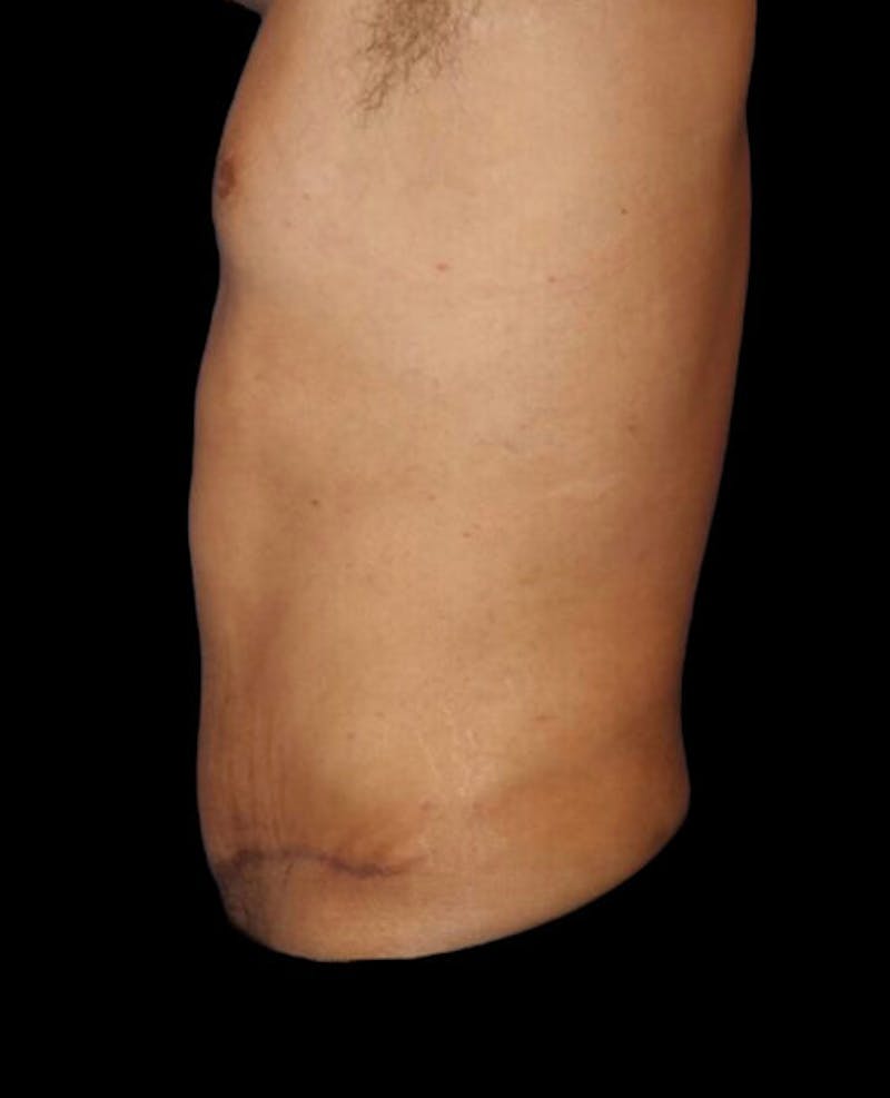 Male Liposuction Before & After Gallery - Patient 280853 - Image 6