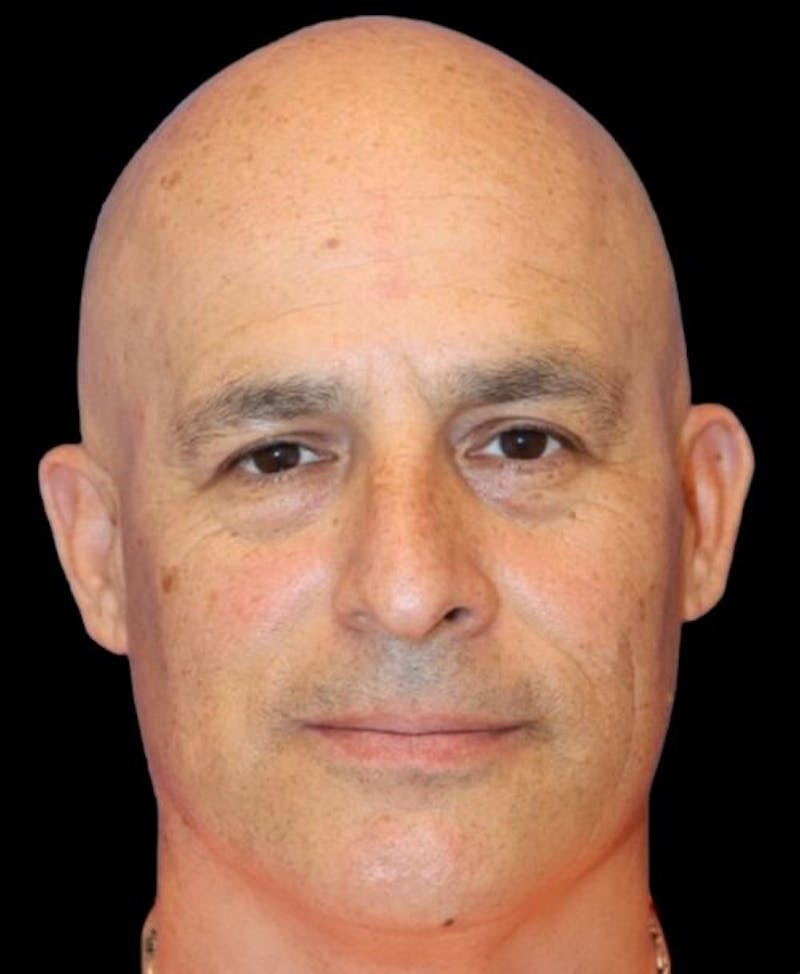 Blepharoplasty (Eyelid Surgery) Before & After Gallery - Patient 355960 - Image 1