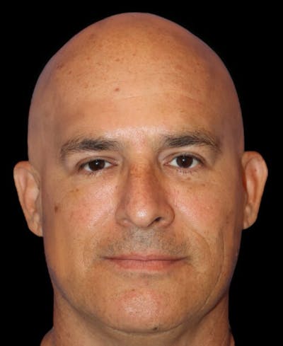 Blepharoplasty Before & After Gallery - Patient 225782 - Image 2