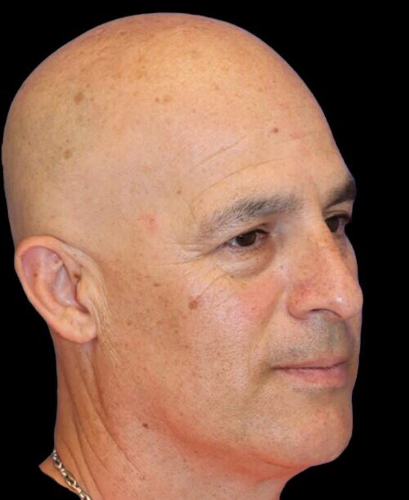 Blepharoplasty (Eyelid Surgery) Before & After Gallery - Patient 355960 - Image 3