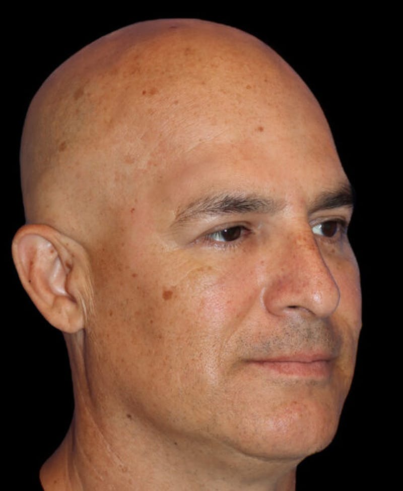 Blepharoplasty (Eyelid Surgery) Before & After Gallery - Patient 355960 - Image 4