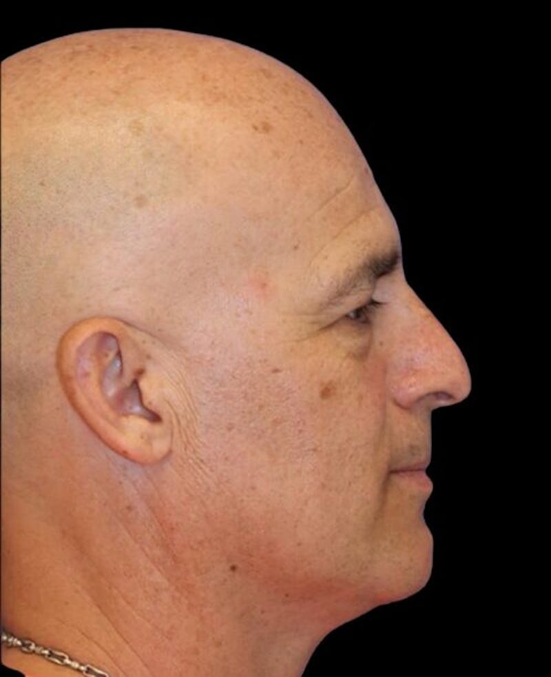 Blepharoplasty (Eyelid Surgery) Before & After Gallery - Patient 355960 - Image 5