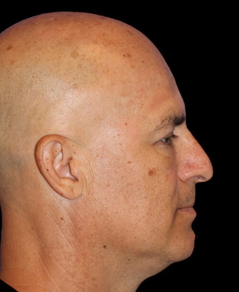 Blepharoplasty (Eyelid Surgery) Before & After Gallery - Patient 355960 - Image 6