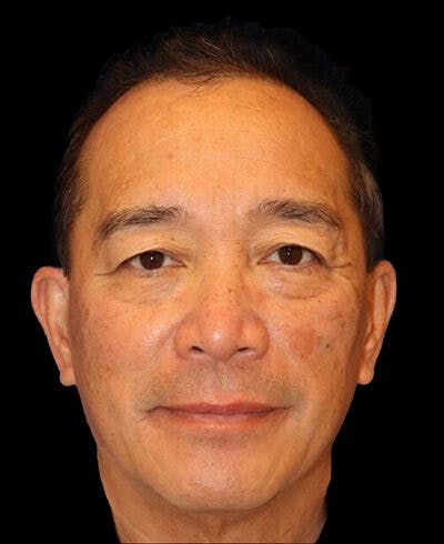 Blepharoplasty Before & After Gallery - Patient 721888 - Image 1