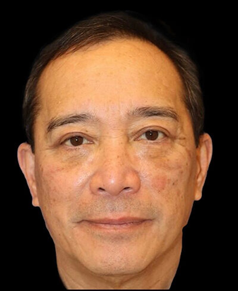 Blepharoplasty Before & After Gallery - Patient 721888 - Image 2