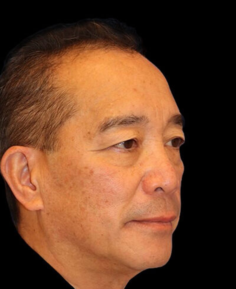 Blepharoplasty Before & After Gallery - Patient 721888 - Image 3