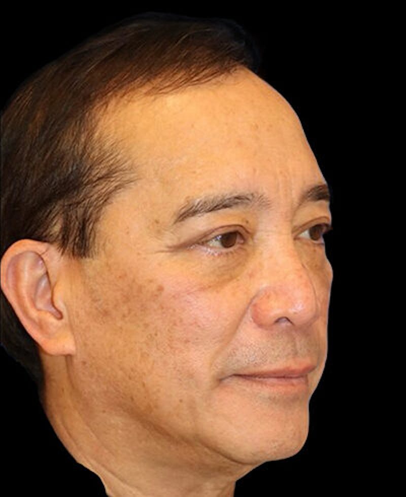 Blepharoplasty Before & After Gallery - Patient 721888 - Image 4