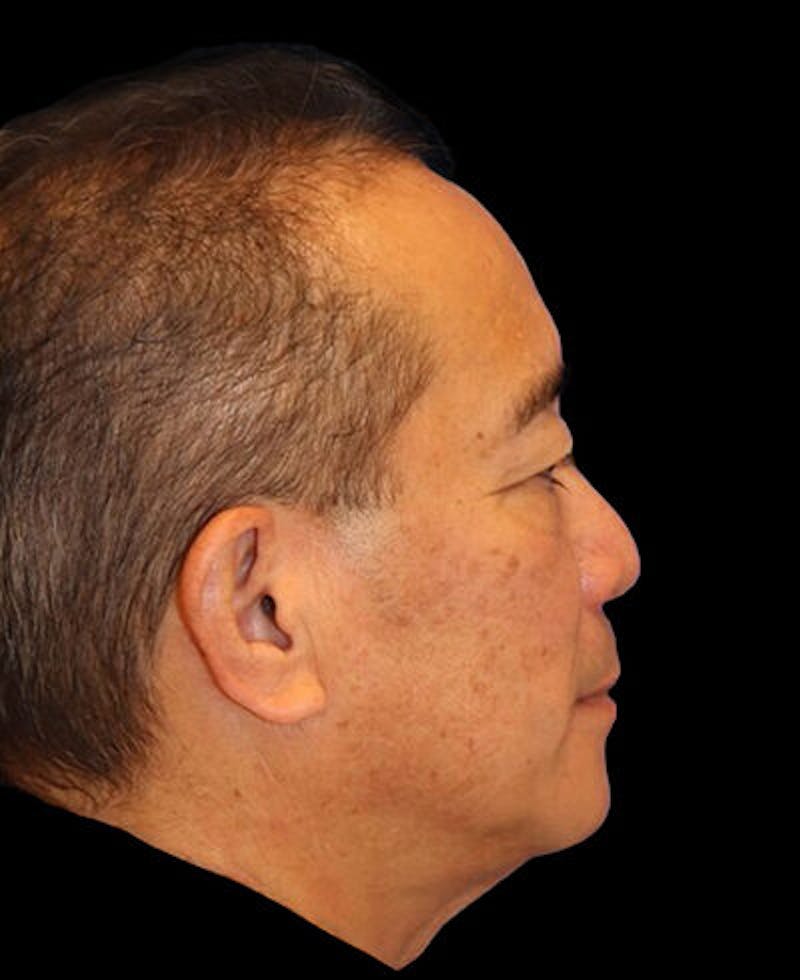 Blepharoplasty Before & After Gallery - Patient 721888 - Image 5