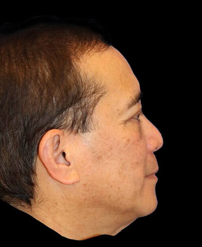 Blepharoplasty Before & After Gallery - Patient 721888 - Image 6