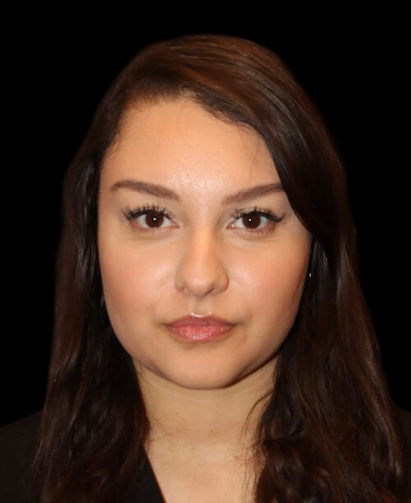 Facial Optimization Before & After Gallery - Patient 208660 - Image 1