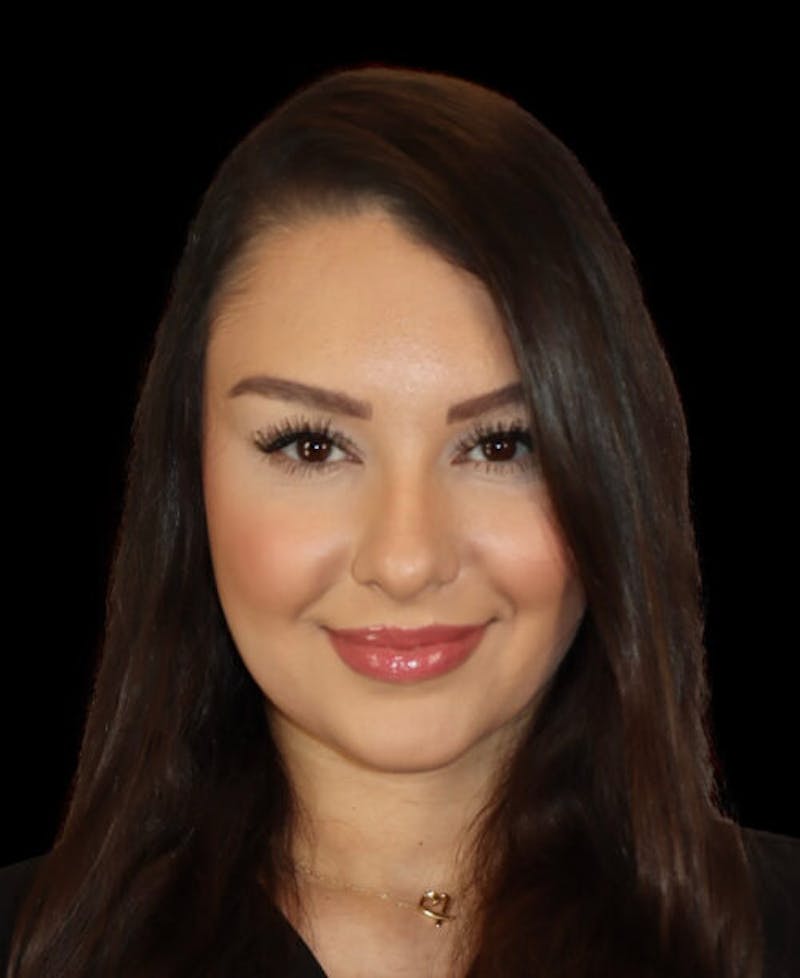 Facial Optimization Before & After Gallery - Patient 208660 - Image 2