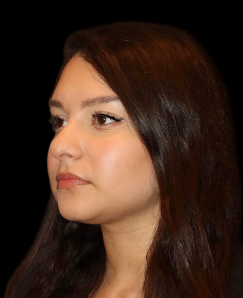 Facial Optimization Before & After Gallery - Patient 208660 - Image 3