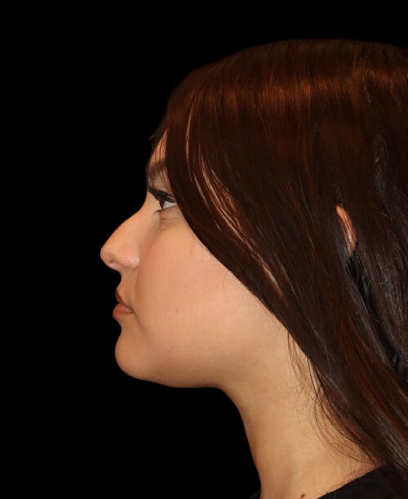 Facial Optimization Before & After Gallery - Patient 208660 - Image 5