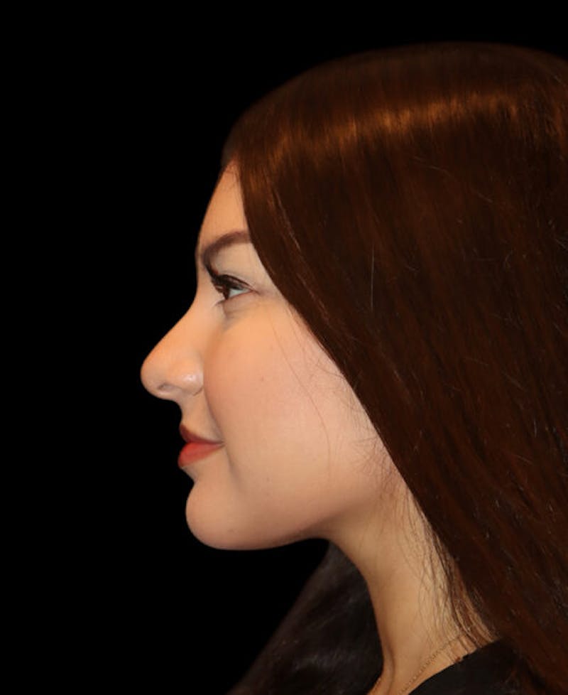 Facial Optimization Before & After Gallery - Patient 208660 - Image 6