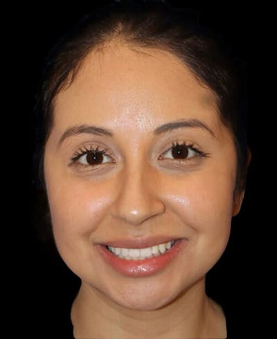 Facial Optimization Before & After Gallery - Patient 288658 - Image 1