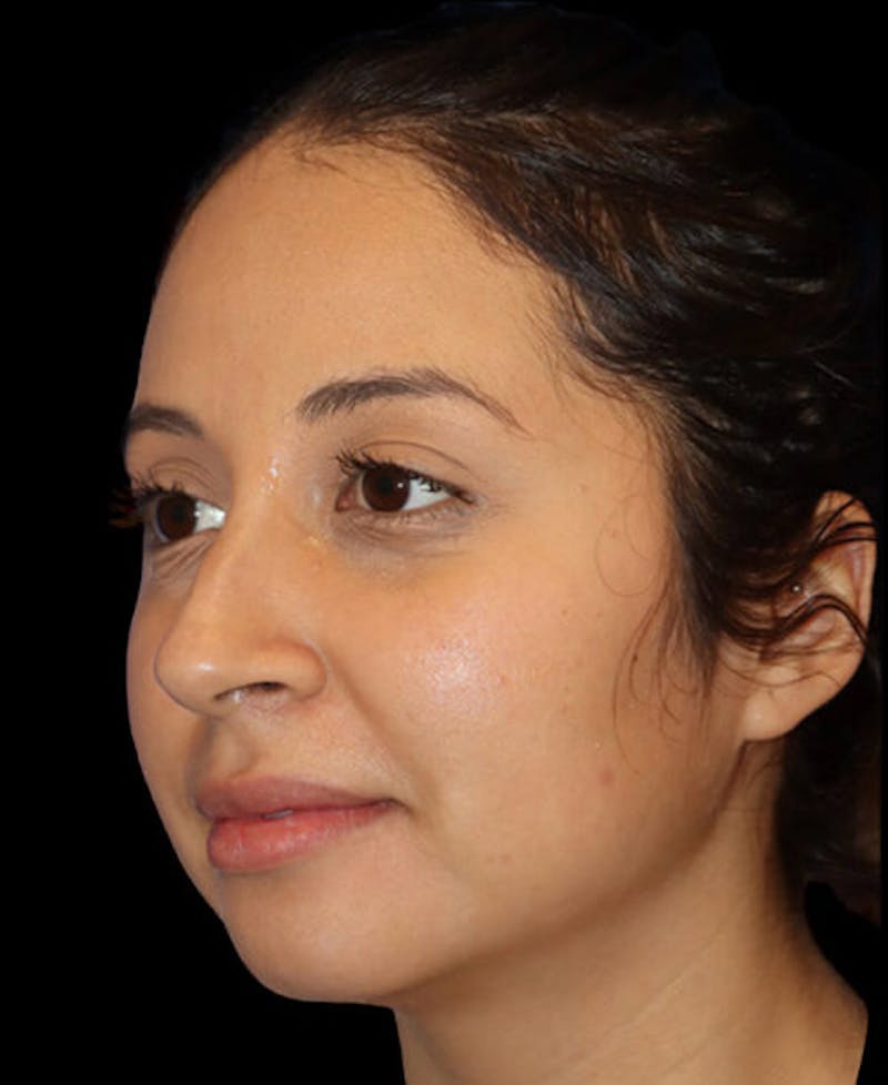 Facial Optimization Before & After Gallery - Patient 288658 - Image 3