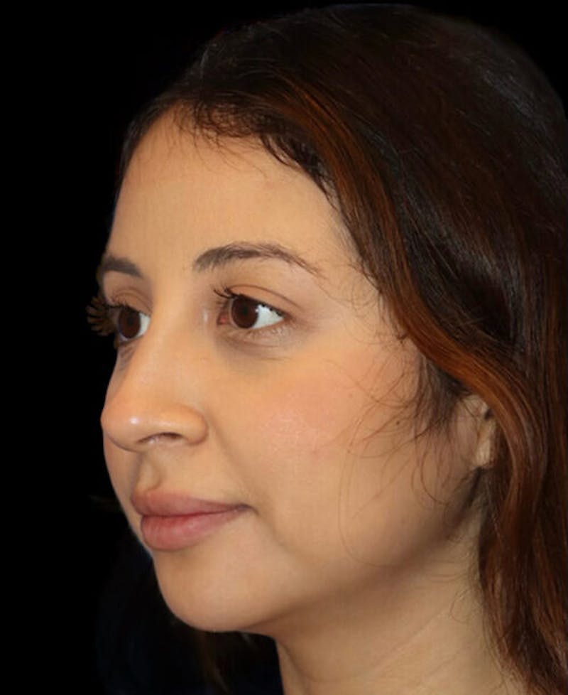 Facial Optimization Before & After Gallery - Patient 288658 - Image 4