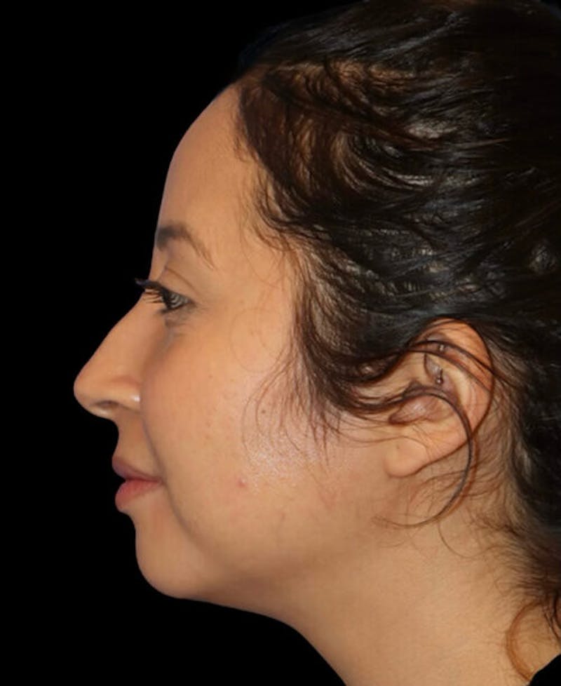 Facial Optimization Before & After Gallery - Patient 288658 - Image 5
