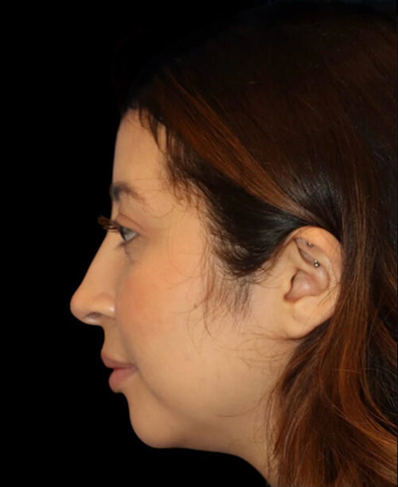 Facial Optimization Before & After Gallery - Patient 288658 - Image 6