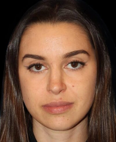 Facial Optimization Before & After Gallery - Patient 185296 - Image 1