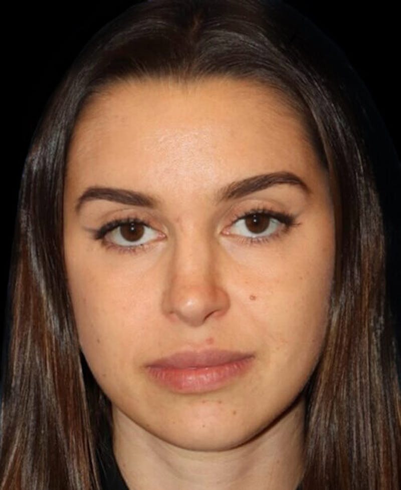 Facial Optimization Before & After Gallery - Patient 185296 - Image 1