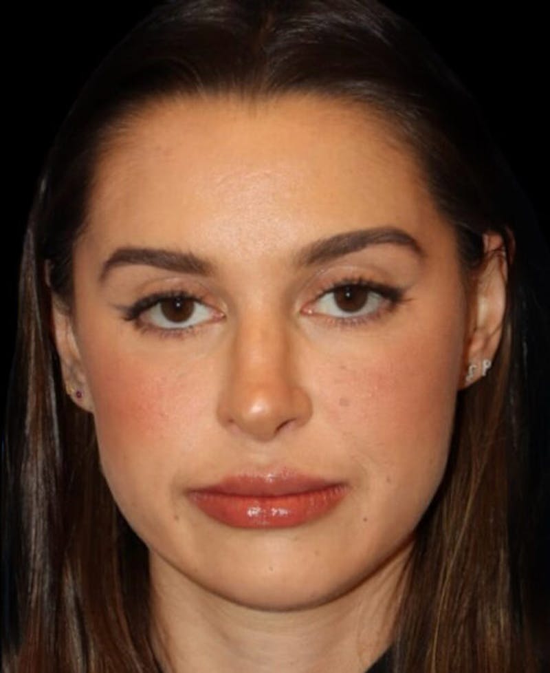 Facial Optimization Before & After Gallery - Patient 185296 - Image 2