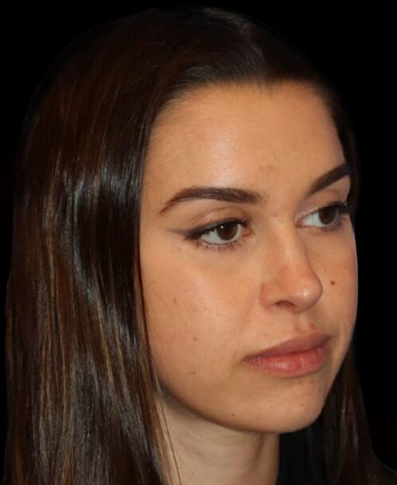 Facial Optimization Before & After Gallery - Patient 185296 - Image 3