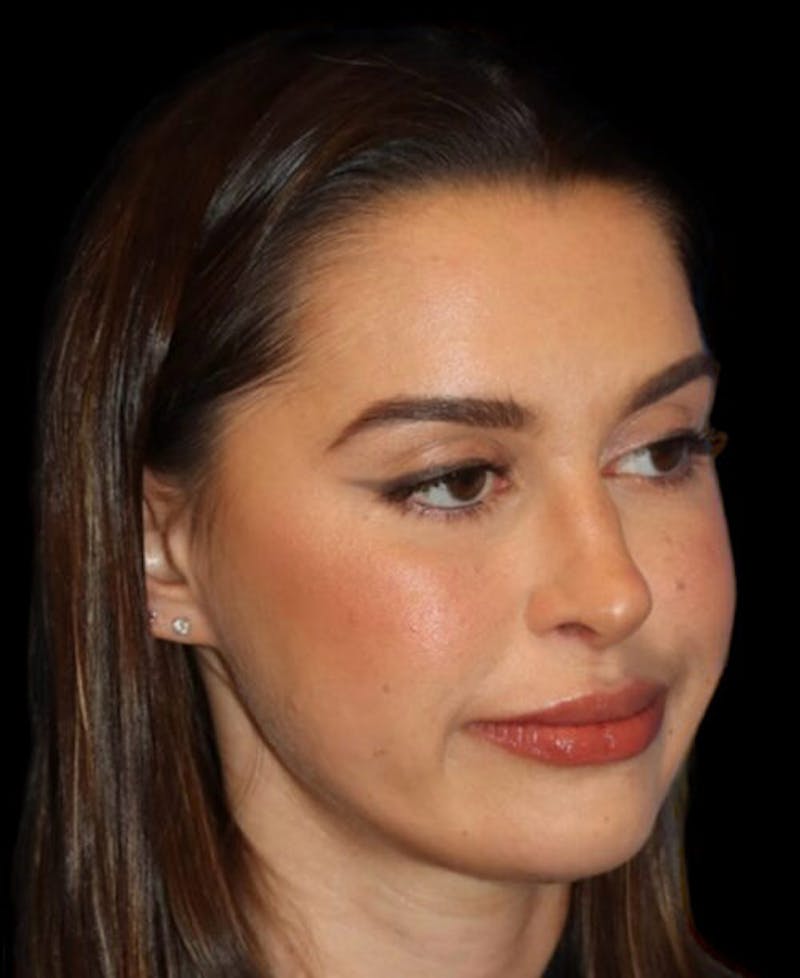 Facial Optimization Before & After Gallery - Patient 185296 - Image 4