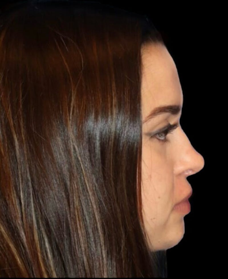 Facial Optimization Before & After Gallery - Patient 185296 - Image 5