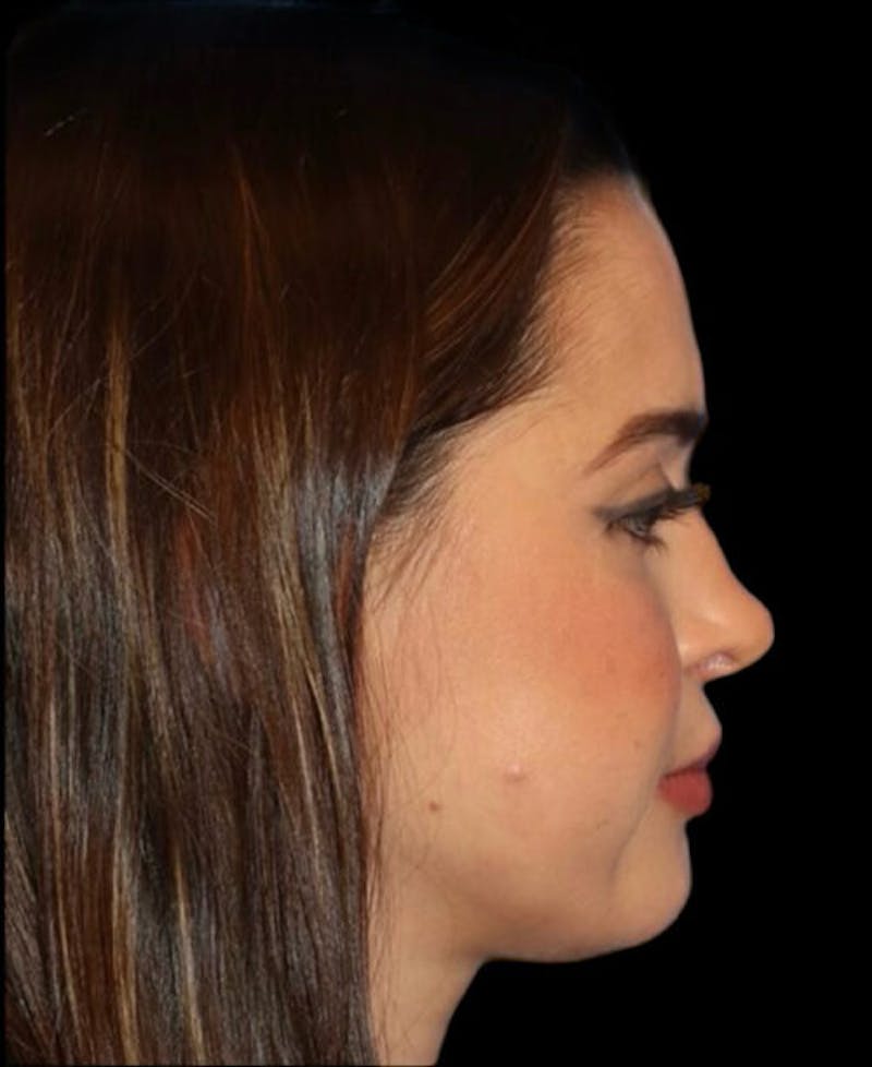 Facial Optimization Before & After Gallery - Patient 185296 - Image 6