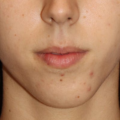 Gummy Smile Correction Before & After Gallery - Patient 142296 - Image 1