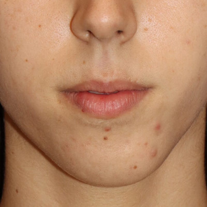 Gummy Smile Correction Before & After Gallery - Patient 142296 - Image 1