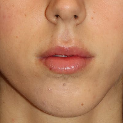 Gummy Smile Correction Before & After Gallery - Patient 142296 - Image 2