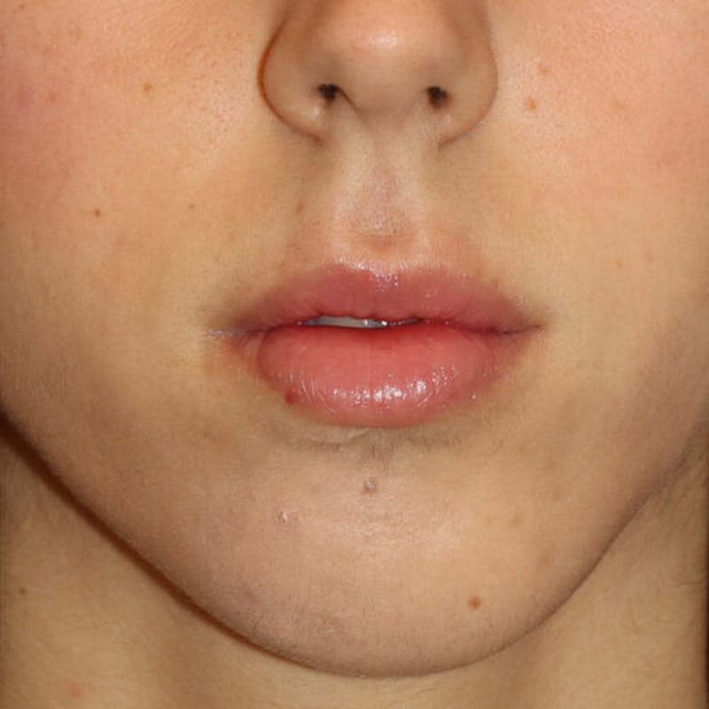 Gummy Smile Correction Before & After Gallery - Patient 142296 - Image 2