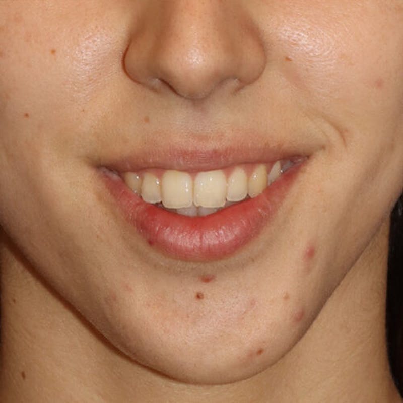 Gummy Smile Correction Before & After Gallery - Patient 142296 - Image 3